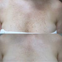 IPL Before & After Gallery - Patient 3199493 - Image 1