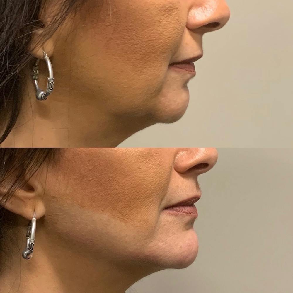 Jawline Before & After Gallery - Patient 3199554 - Image 1