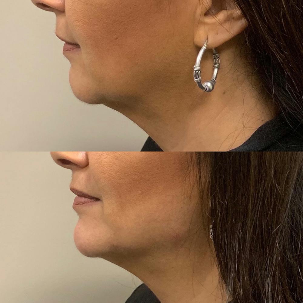 Jawline Before & After Gallery - Patient 3199555 - Image 1
