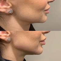 Jawline Before & After Gallery - Patient 3199556 - Image 1