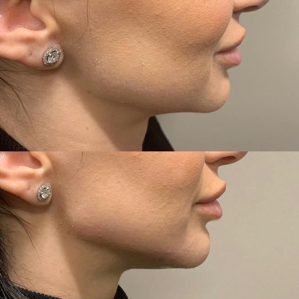 Jawline Before & After Gallery - Patient 3199556 - Image 1
