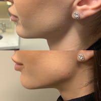 Jawline Before & After Gallery - Patient 3199557 - Image 1