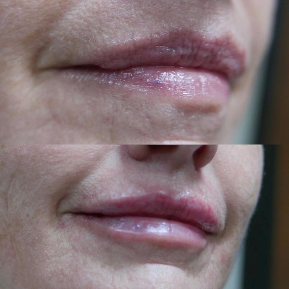 Lips Before & After Gallery - Patient 3199627 - Image 1