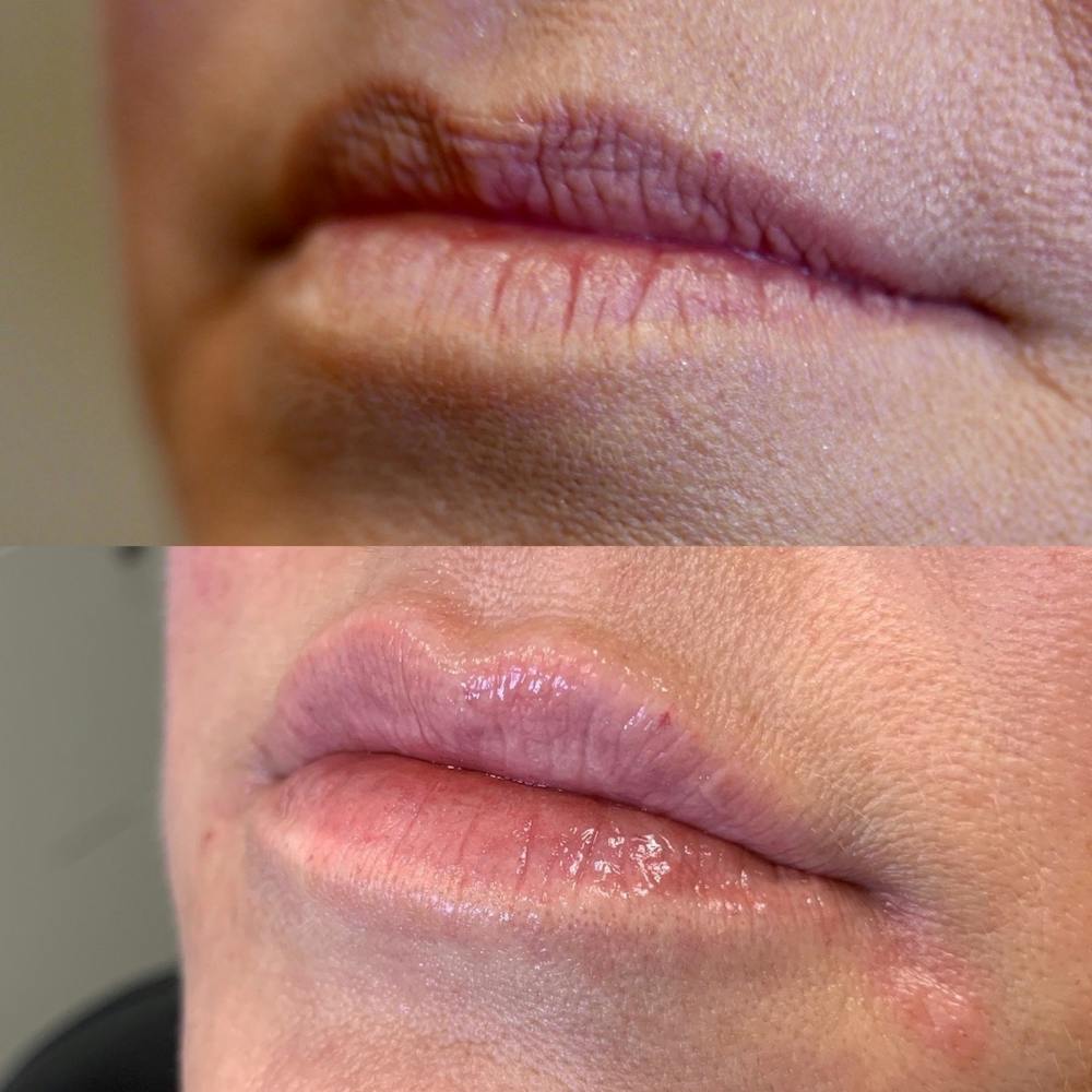 Lips Before & After Gallery - Patient 3199628 - Image 1