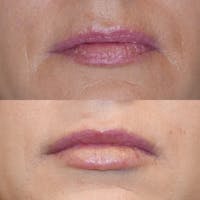 Lips Before & After Gallery - Patient 3199629 - Image 1