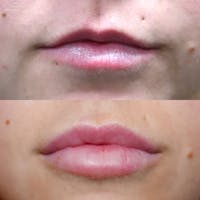 Lips Before & After Gallery - Patient 3199630 - Image 1