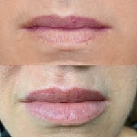Lips Before & After Gallery - Patient 3199631 - Image 1