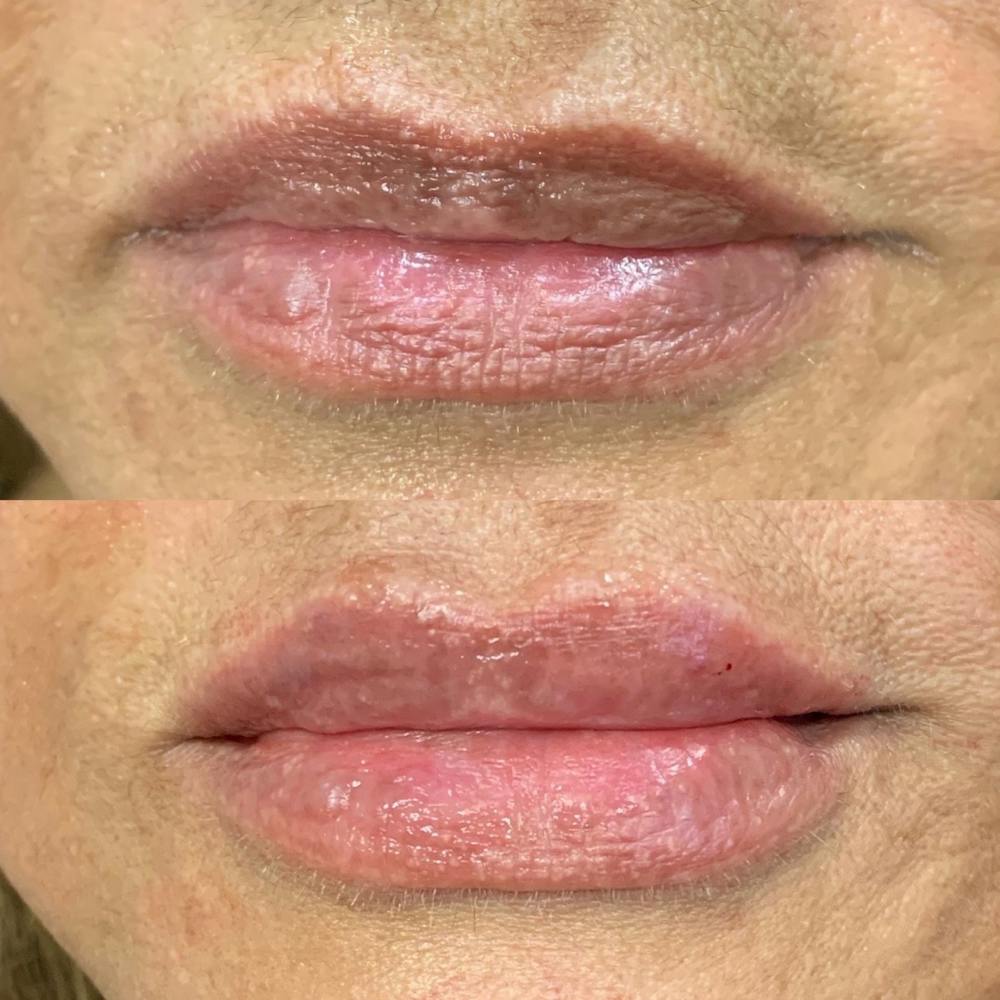 Lips Before & After Gallery - Patient 3199632 - Image 1