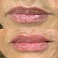 Lips Before & After Gallery - Patient 3199632 - Image 1