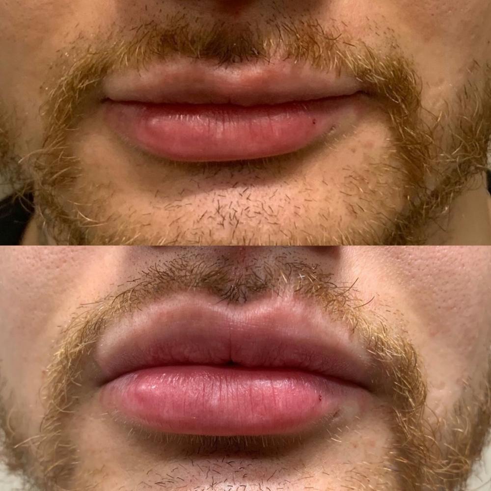 Lips Before & After Gallery - Patient 3199633 - Image 1