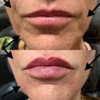 Lips Before & After Gallery - Patient 3199634 - Image 1