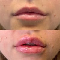 Lips Before & After Gallery - Patient 3199635 - Image 1