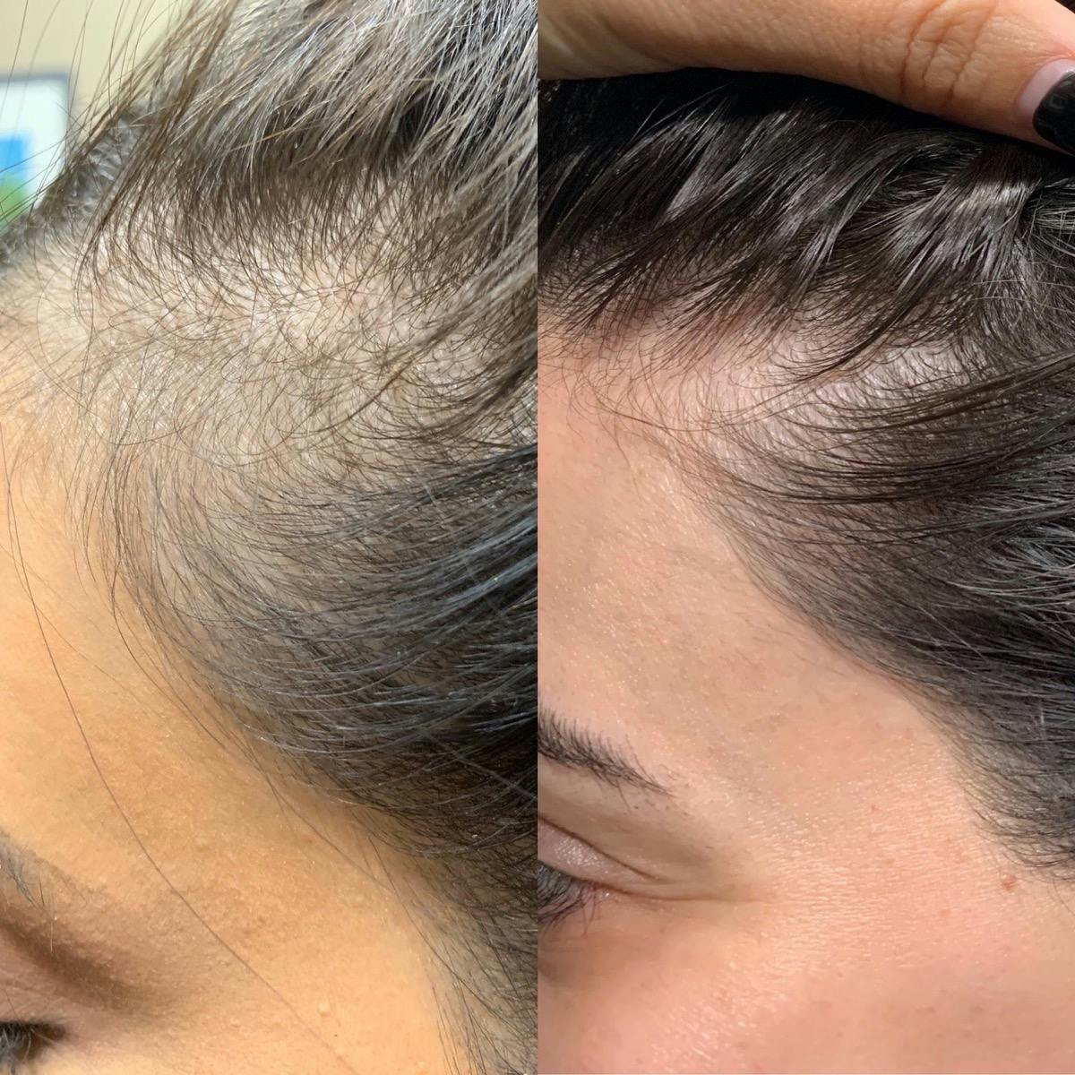 PRP for Hair Before and After Skin Matrx