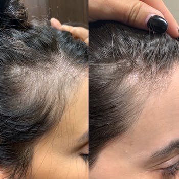 Hair Restoration At Skin Matrx In Burbank Thinning Hair Glendale