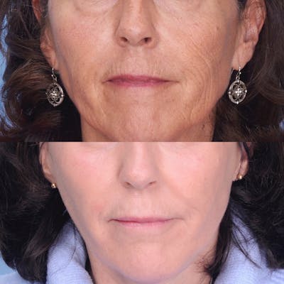 CO2 Laser Before & After Gallery - Patient 3199740 - Image 1