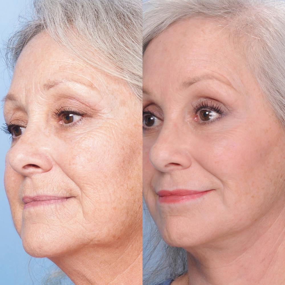 CO2 Laser Before & After Gallery - Patient 3199741 - Image 1