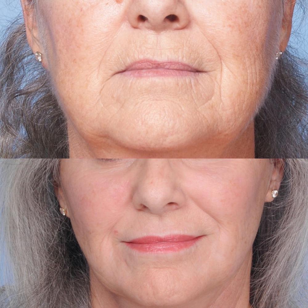 CO2 Laser Before & After Gallery - Patient 3199742 - Image 1
