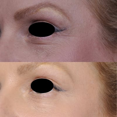 CO2 Laser Before & After Gallery - Patient 3199743 - Image 1