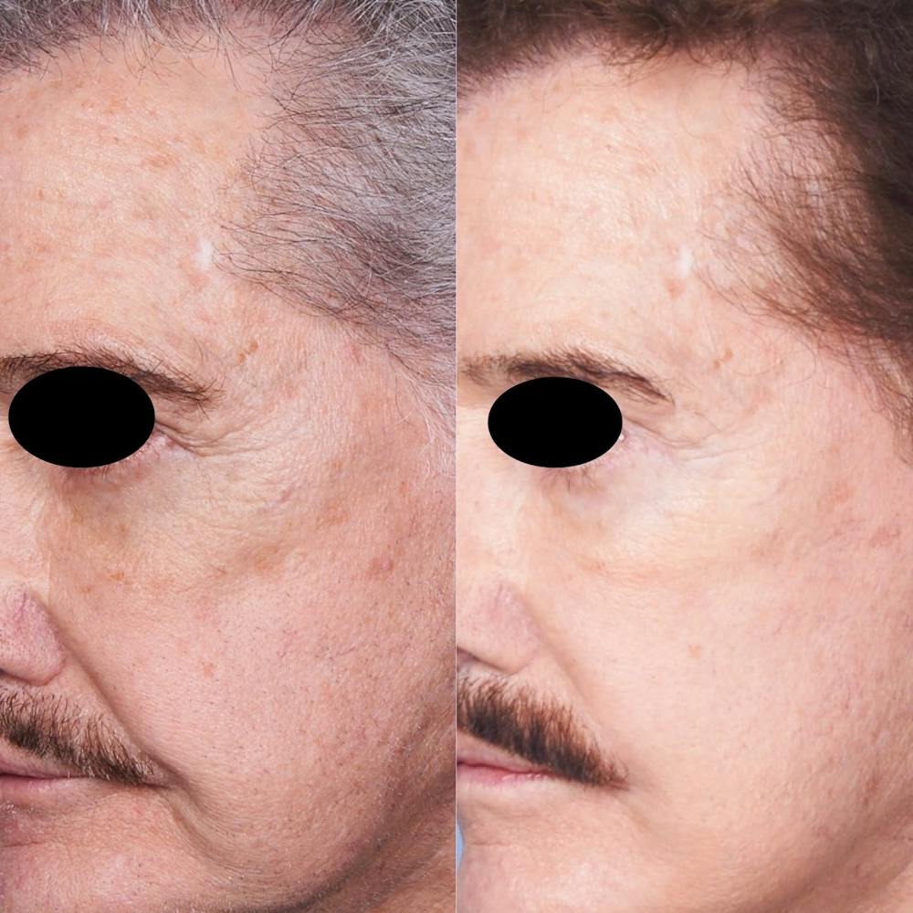 CO2 Laser Before & After Gallery - Patient 3199744 - Image 1