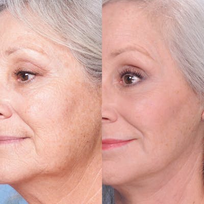 CO2 Laser Before & After Gallery - Patient 3199746 - Image 1
