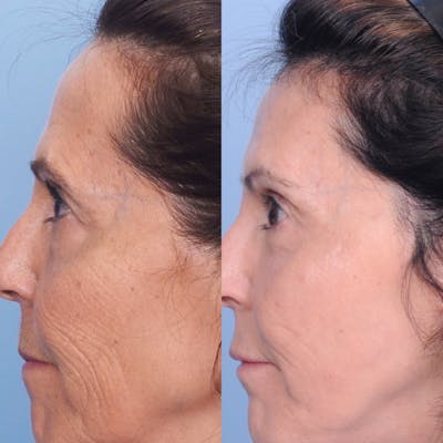 CO2 Laser Before & After Gallery - Patient 3199747 - Image 1