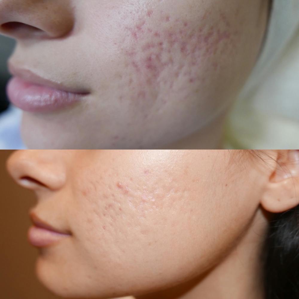 Skin Pen Microneedling Before & After Gallery - Patient 3199776 - Image 1