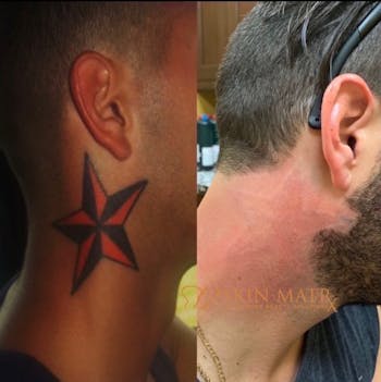 Laser Tattoo Removal Burbank | Laser Tattoo Removal Glendale