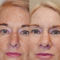 Chemical Peel Before & After Gallery - Patient 3376119 - Image 1