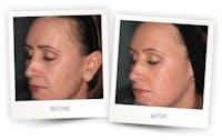 Erbium Pixel Laser Before & After Gallery - Patient 3267345 - Image 1