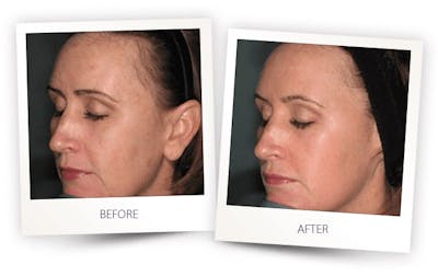 Erbium Pixel Laser Before & After Gallery - Patient 3267345 - Image 1