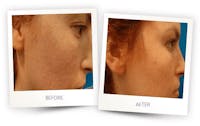 Erbium Pixel Laser Before & After Gallery - Patient 3267346 - Image 1