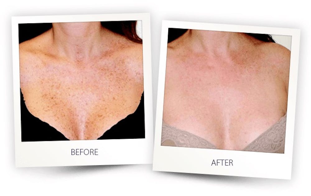 Erbium Pixel Laser Before & After Gallery - Patient 3267347 - Image 1
