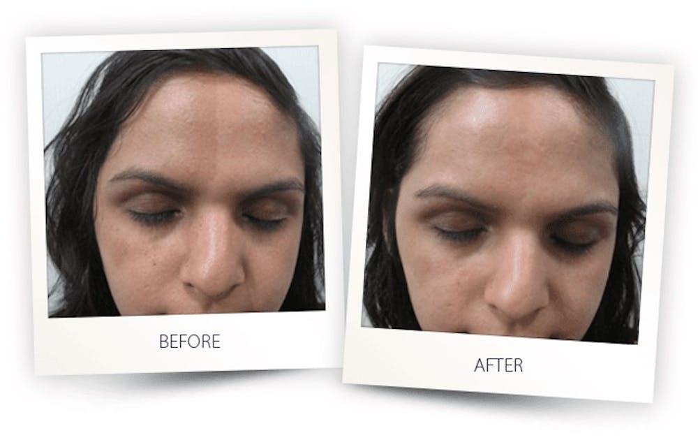 Erbium Pixel Laser Before & After Gallery - Patient 3267348 - Image 1