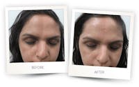 Erbium Pixel Laser Before & After Gallery - Patient 3267348 - Image 1