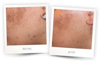Erbium Pixel Laser Before & After Gallery - Patient 3267349 - Image 1