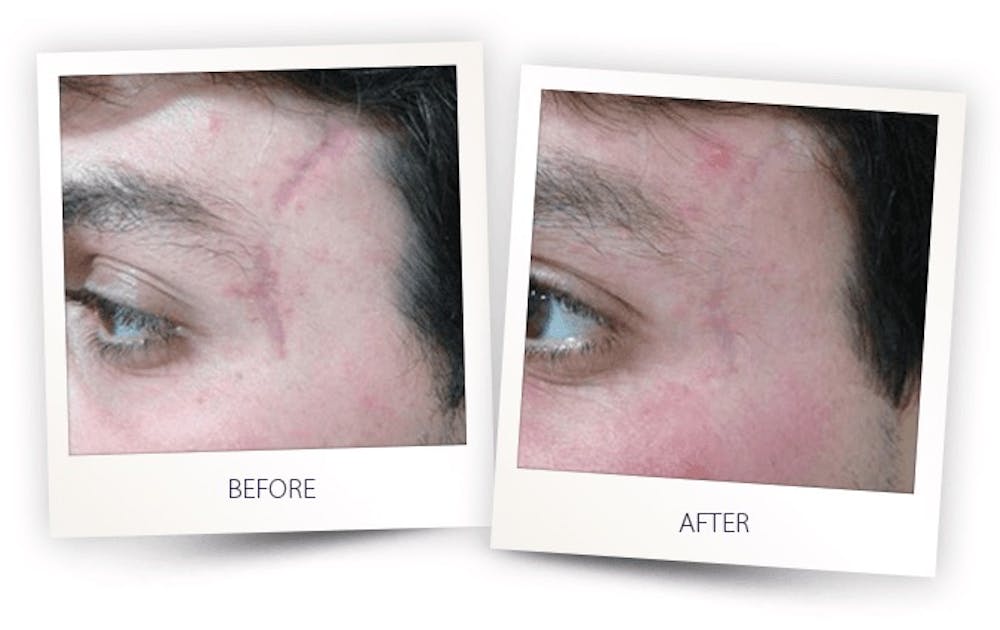Erbium Pixel Laser Before & After Gallery - Patient 3267350 - Image 1