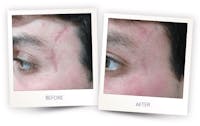Erbium Pixel Laser Before & After Gallery - Patient 3267350 - Image 1