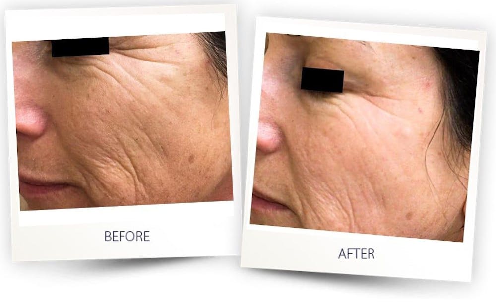 Erbium Pixel Laser Before & After Gallery - Patient 3267352 - Image 1