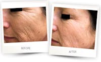 Erbium Pixel Laser Before & After Gallery - Patient 3267352 - Image 1