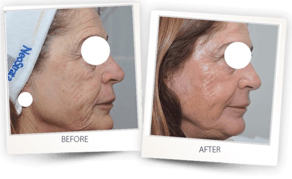 Erbium Pixel Laser Before & After Gallery - Patient 3267353 - Image 1