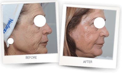 Erbium Pixel Laser Before & After Gallery - Patient 3267353 - Image 1