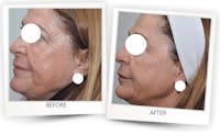 Erbium Pixel Laser Before & After Gallery - Patient 3267354 - Image 1