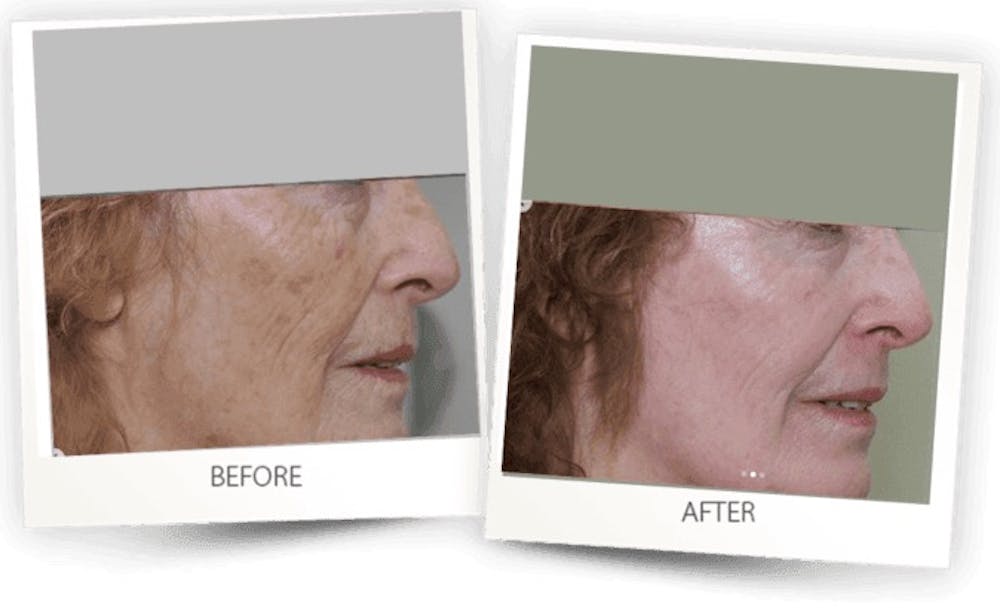 Erbium Pixel Laser Before & After Gallery - Patient 3267355 - Image 1
