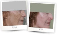 Erbium Pixel Laser Before & After Gallery - Patient 3267355 - Image 1