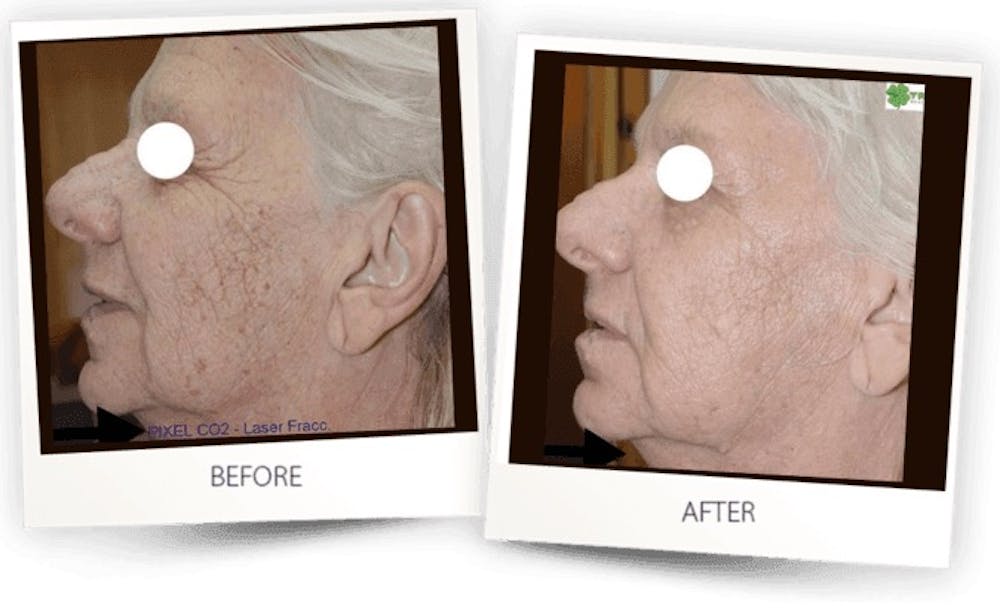 Erbium Pixel Laser Before & After Gallery - Patient 3267356 - Image 1