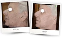 Erbium Pixel Laser Before & After Gallery - Patient 3267356 - Image 1