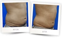 Body Before & After Gallery - Patient 3267385 - Image 1