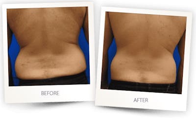 Body Before & After Gallery - Patient 3267386 - Image 1