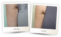 Body Before & After Gallery - Patient 3267395 - Image 1
