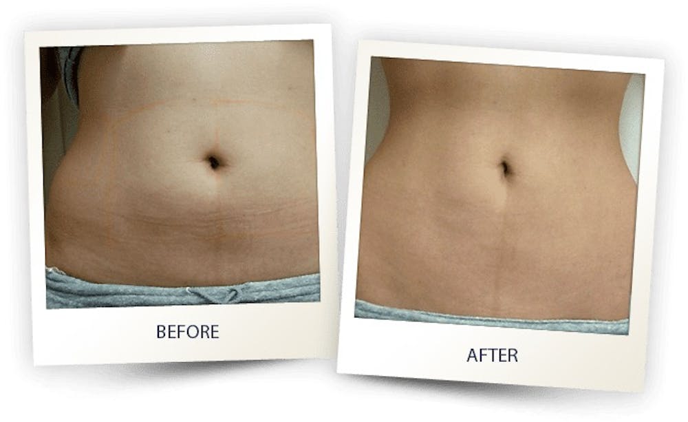 Body Before & After Gallery - Patient 3267396 - Image 1